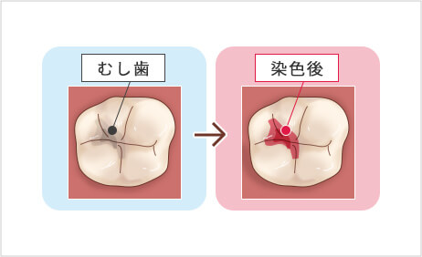 う蝕（むし歯）検知液