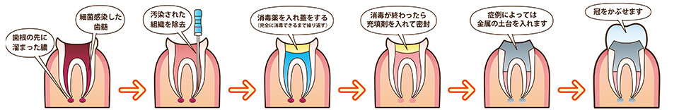 根管治療​​​