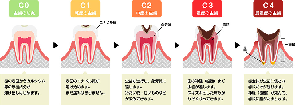 むし歯の進行